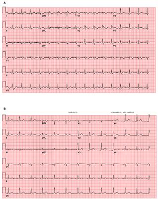 Electrocardiographic Risk Stratification in COVID-19 Patients